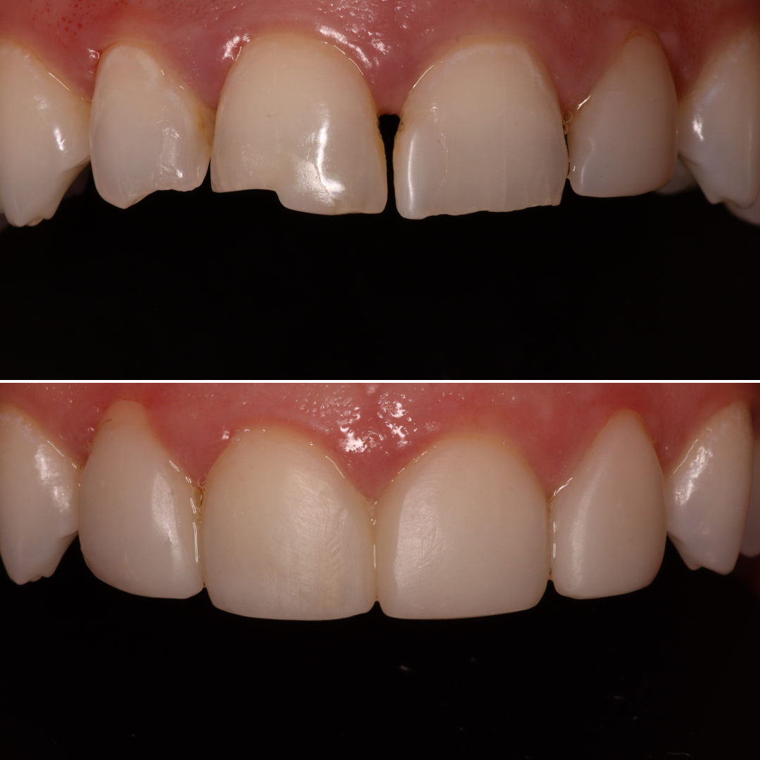 Before & After Dental Bonding in Salt Lake City, UT